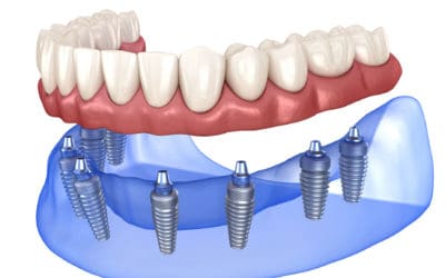 Overdentures: What are they?