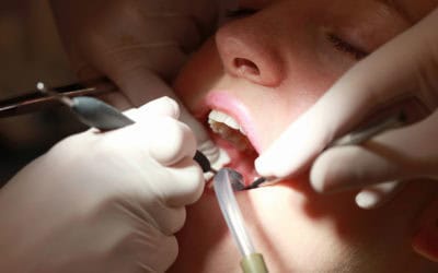 Root Canal: The Alternative to Teeth Extractions